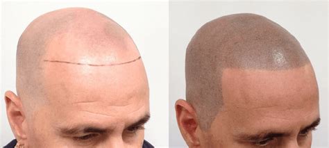 What Causes Alopecia Areata Trends Magazine