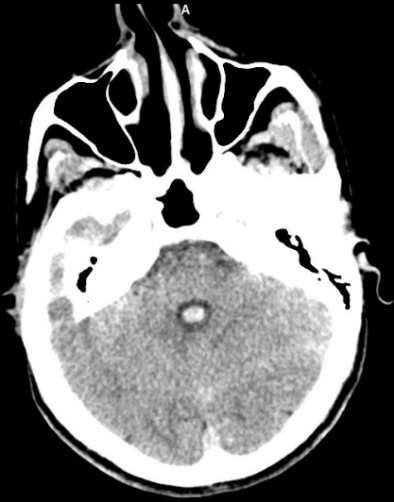 Preoperative Ct Scan Intraventricular Hemorrhage In The Fourth And