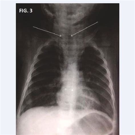 Shows Subcutaneous And Paratracheal Emphysema Download Scientific