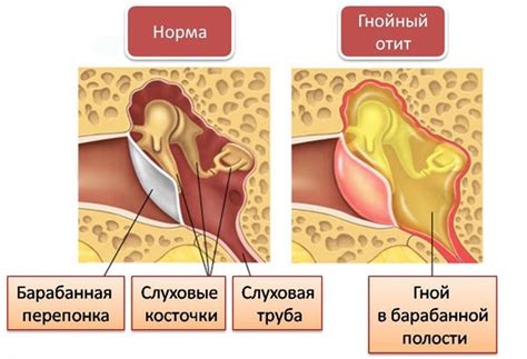 Purulent Otitis In The Child Causes Symptoms Treatment At Home