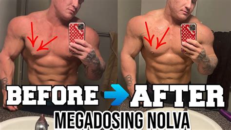 Megadosing Nolvadex To Reduce My Gynecomastia Experiment Youtube
