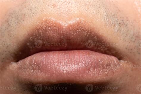 Close Up Of Fordyce Spots On Lips 8878578 Stock Photo At Vecteezy