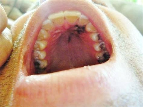 Melanoma On The Roof Of Mouth You Can Get It Anywhere Melanoma