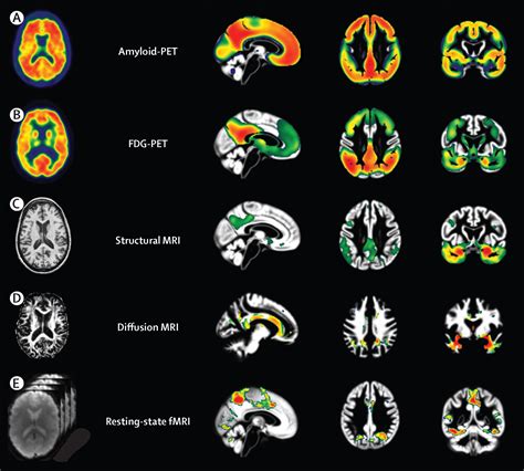 Multimodal Imaging In Alzheimers Disease Validity And Usefulness For