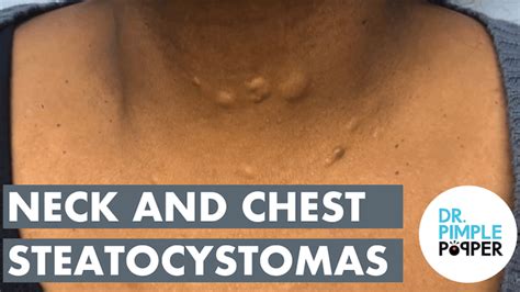 Steatocystoma City Session 3 Steatocystoma Station Dr Pimple Popper