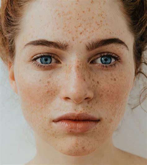 How To Get Rid Of Freckles On Face Without Makeup Saubhaya Makeup