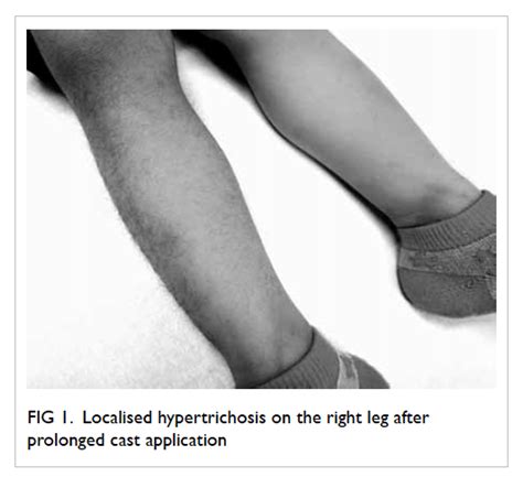 Limiting blood flow to the scalp exacerbates the. Acquired localised hypertrichosis in a Chinese child after ...