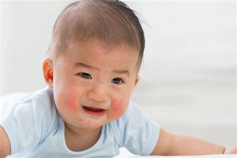 Baby Rashes Type Of Rashes And Treatment Parenting Circle
