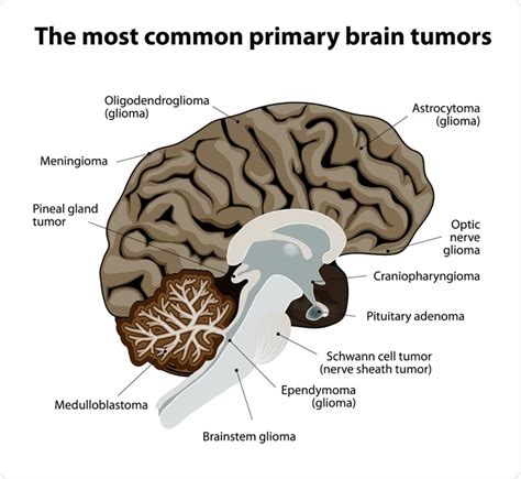 What Is A Diffuse Intrinsic Pontine Glioma DIPG