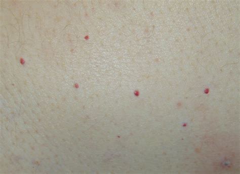 Rash Pinpoint Red Dots On Skin Interactivemain