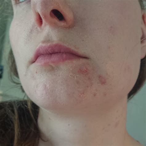 Fourth Month Of 005 Tretinoin Lotion For Cystic Acne Use Every Third