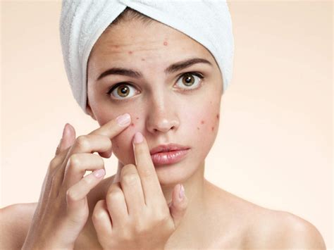 Healthy Habits To Prevent Acne 5 Daily Habits That Can Prevent Acne
