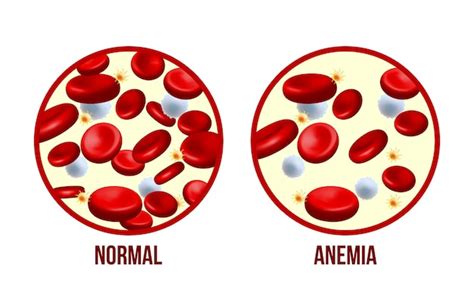 Anémie Ferriprive La Différence Entre La Quantité De Globules Rouges