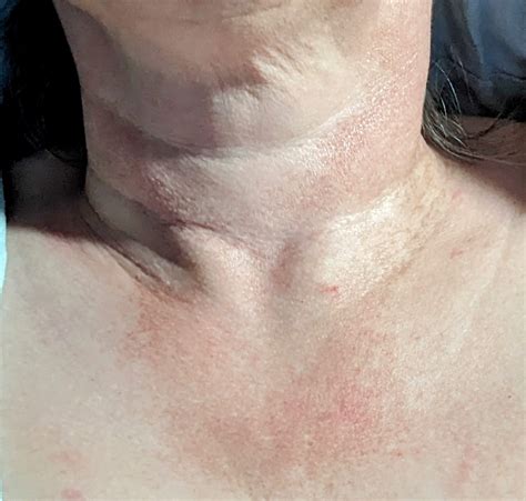 Red Rash On Neckchest Rdermatologyquestions