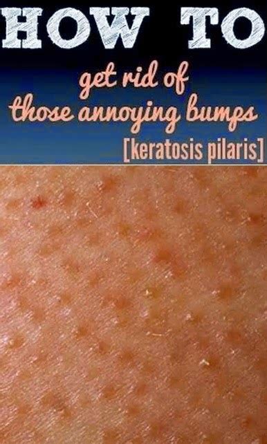 Bumpy Itchy Rash On Hands And Arms Hard Lump Under Baby Skin How To