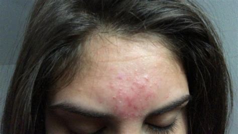 What Is This Forehead Acne Wont Go Away General Acne Discussion