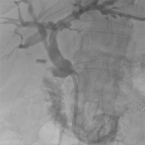 Cholangiogram Performed Via An Indwelling 10french Biliary Drainage