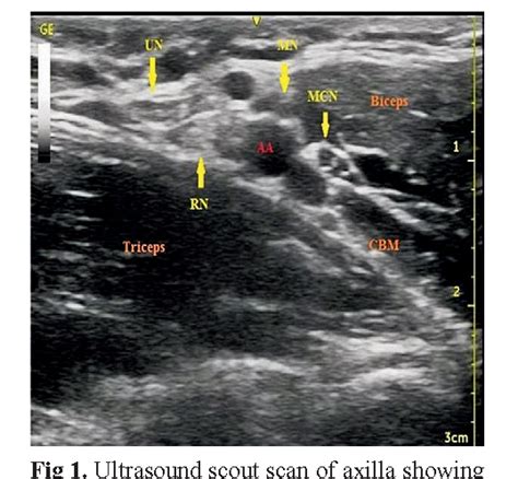 Figure 1 From Ultrasound Guided Axillary Brachial Plexus Block