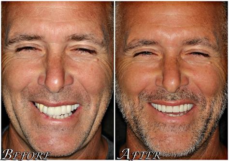 All On Dental Implants Before And After Photos Center Smiles