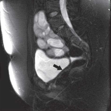 Affected women usually do not have menstrual periods. MRI showing pelvic kidney and absent uterus (Arrow) | Open-i