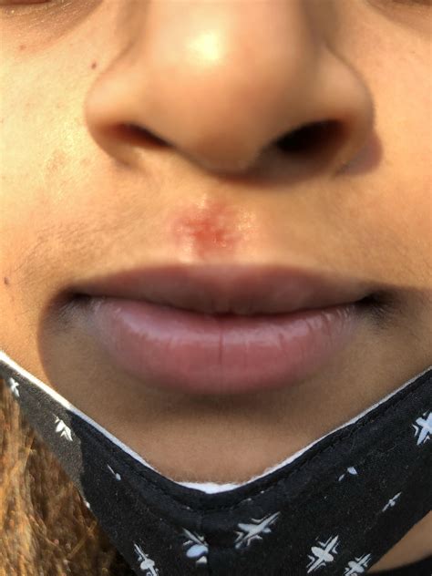Skin Concern Scabrash On Upper Lip Rskincareaddiction