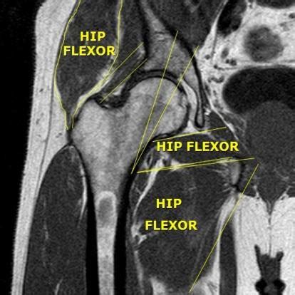 Participation in certain sports increases your risk of developing hip flexor strains. Hip Flexor Strain: Signs, Causes, Treatment and Recovery ...