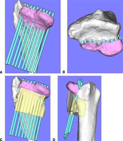 Corrective Osteotomy For Malunited Intra Articular Fracture Of The