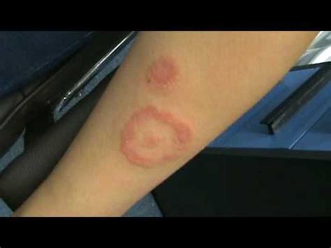 Bullseye Rashes Ringworm And Lyme Disease Differences Healdove