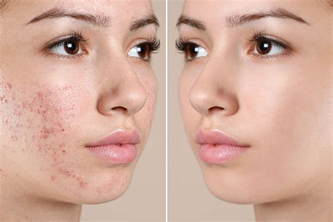 Acne Treatment Near Me In Jacksonville Fl Annazur