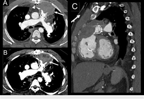 Ct Pulmonary Angiogram Of The Chest Showing The Mediastinal Abscess