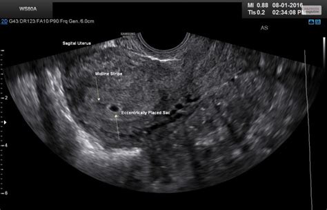 Ultrasound Of A 5 Week Pregnancy