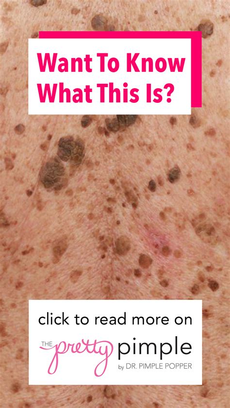 These Wart Like Spots Are Called Seborrheic Keratoses But What Does