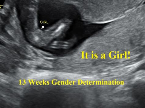 10 Week Ultrasound Girl
