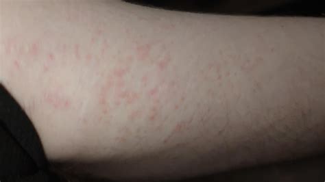 Minor Rash Arm Near Armpit It Is Not An Allergic Reaction To My