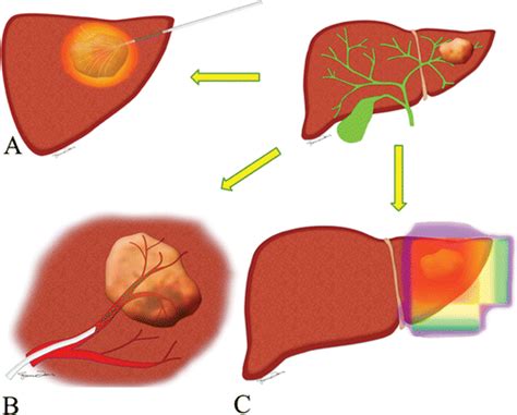 Image Guided Treatment In The Hepatobiliary System Role Of Imaging In