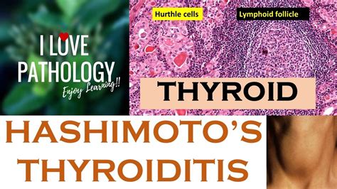 Thyroiditis Thyroiditis Types Causes Symptoms Diagnosis Treatment