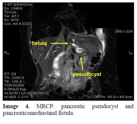 Successful Treatment Of Mediastinal Pancreatic Pseudocyst By Panc