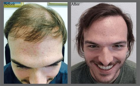 Kevin Before After Finished 1 Hair Transplants Of Florida