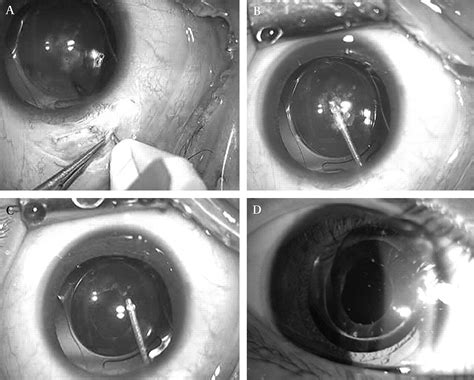 Short Term Outcomes Of Dry Pars Plana Posterior Capsulotomy And