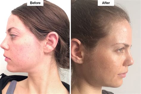 Clear Brilliant Laser Review Can Laser Treatments Make Your Skin