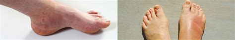 Unexplained Foot Swelling Dr Sami Podiatrist Dubai Dubai Podiatry