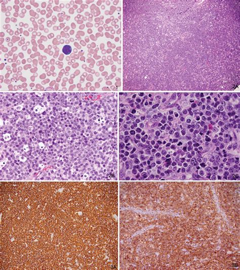 Adult T Cell Leukemialymphoma Archives Of Pathology And Laboratory
