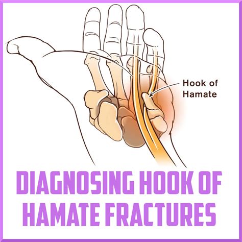 Diagnosing Hook Of Hamate Fractures My Blog