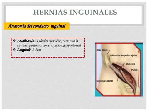 Hernias Abdominales Hernia Femoral Hernia Inguinal