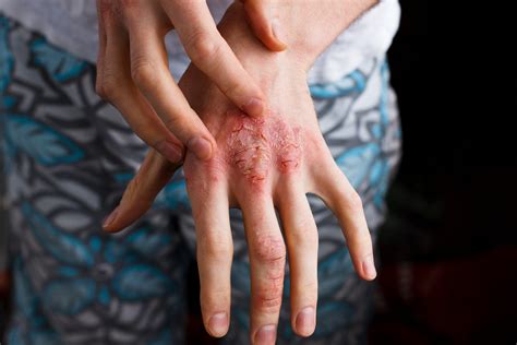 Atopic Dermatitis Hands Treatment