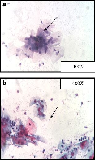 A Conventional PAP Stain High Power View Showing Candida Download Scientific Diagram