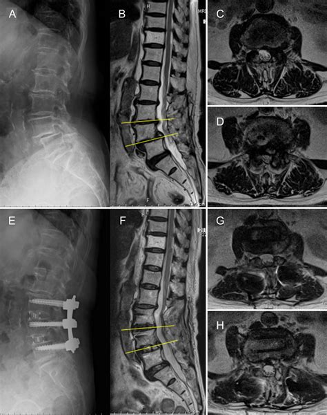 Lateral Lumbar Interbody Fusion In Revision Surgery For Restenosis