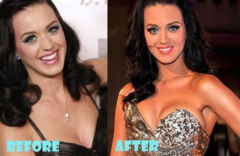 Katy Perry Plastic Surgery Before And After Lovely Surgery Celebrity Before And After Picture