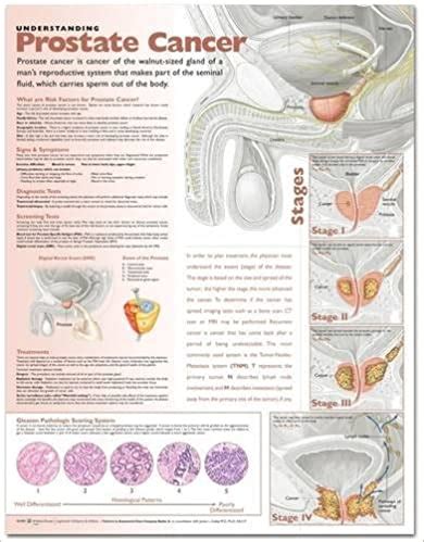 Understanding Prostate Cancer I Surgical Innovative Surgical Supplies