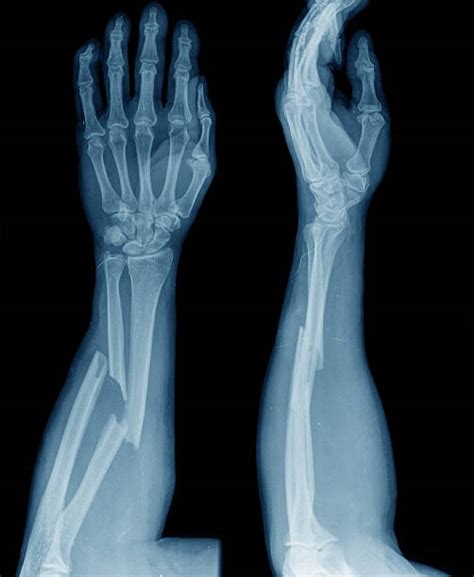 X Rays Of Broken Arm